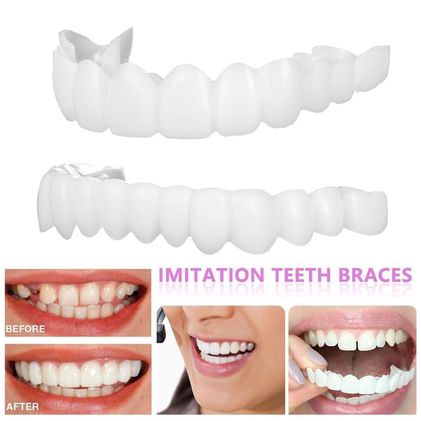 Teeth Whitening For Braces - Zahnprothesen für Ober- und Unterkiefer: Helle