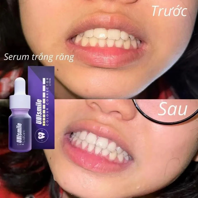 Unismile Teeth Whitening Essen – Teeth Whitening Effective Bewertung und Preis