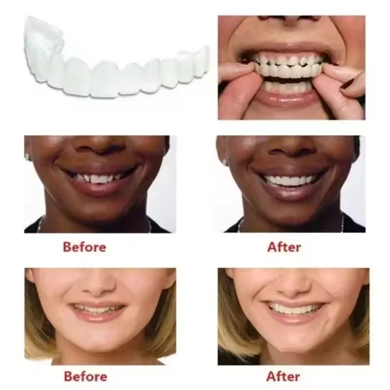 Zahn-Veneers Zahnaufhellung Za – Teeth Whitening For Braces Bewertung und Preis