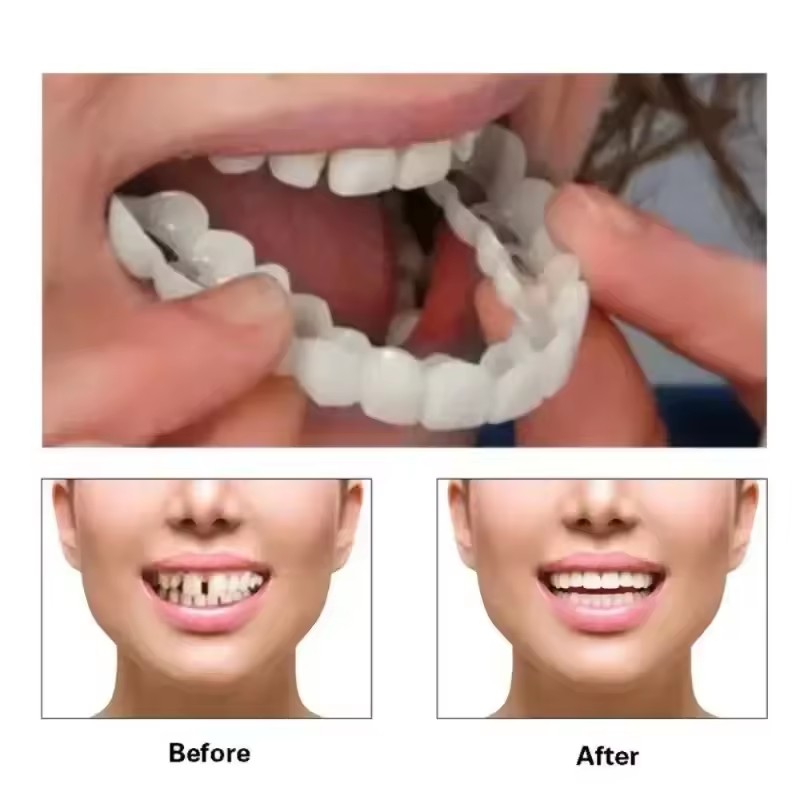 Zahn-Veneers Zahnaufhellung Za – Teeth Whitening For Braces Bewertung und Preis