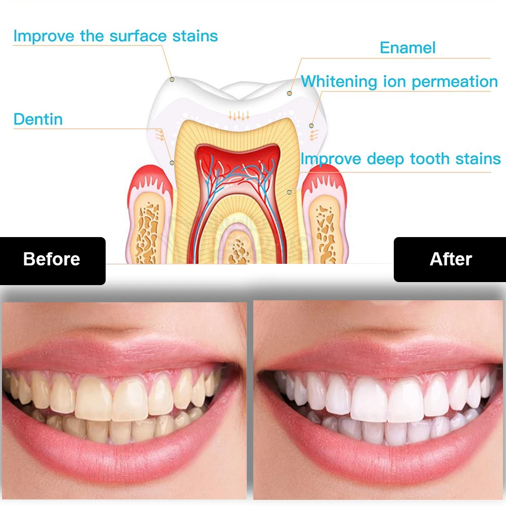 Dental Zahnaufhellung Kit Mini – Teeth Whitening Blue Light Bewertung und Preis