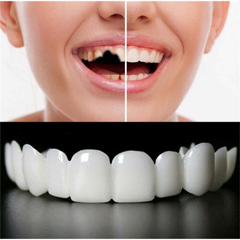[NEU! ABMK】 2 Paar, Wiederhers – Teeth Whitening For Braces Bewertung und Preis