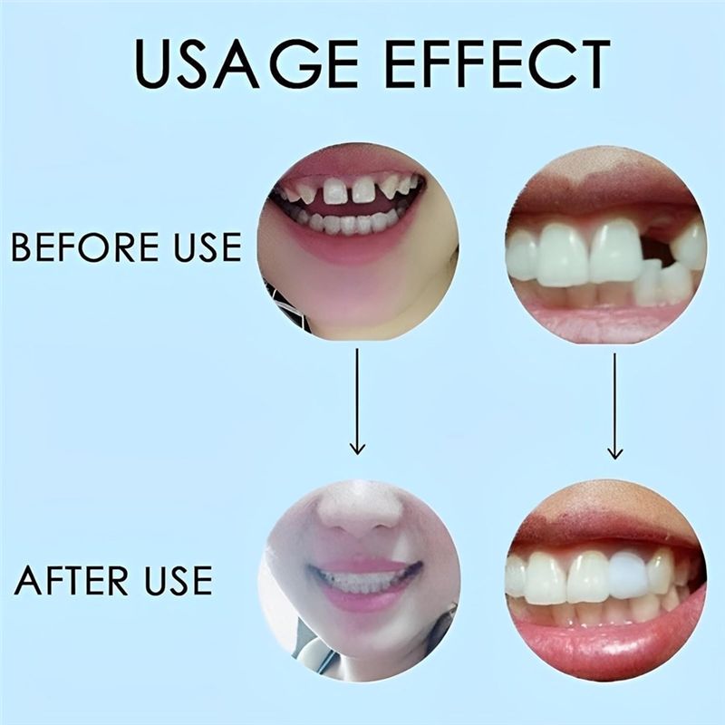 [NEU! ABMK】 2 Paar, Wiederhers – Teeth Whitening For Braces Bewertung und Preis